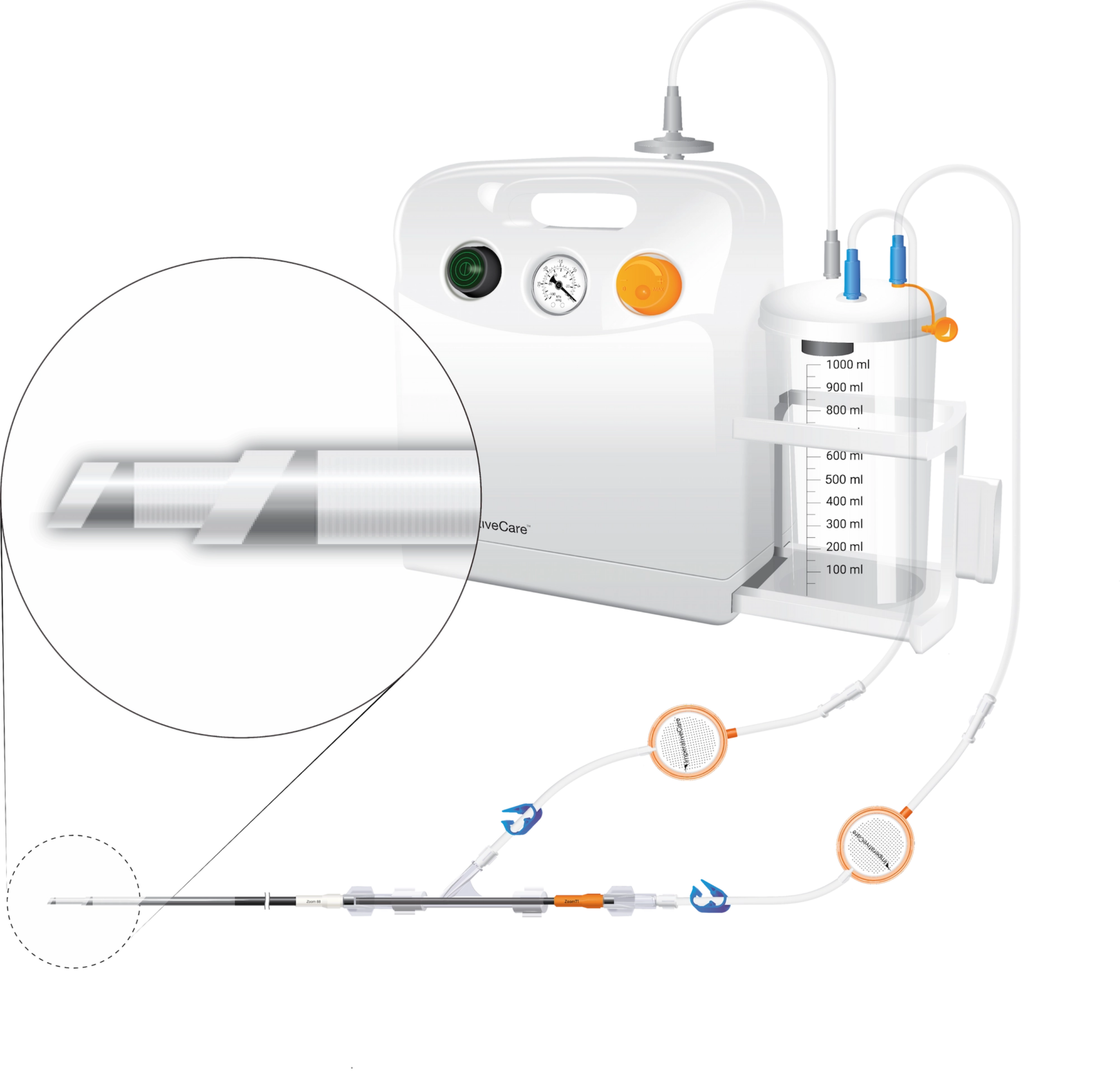 The Zoom Pump aspirating through two Zoom Catheters and two Zoom PODs, with a magnified view of the nested catheter tips