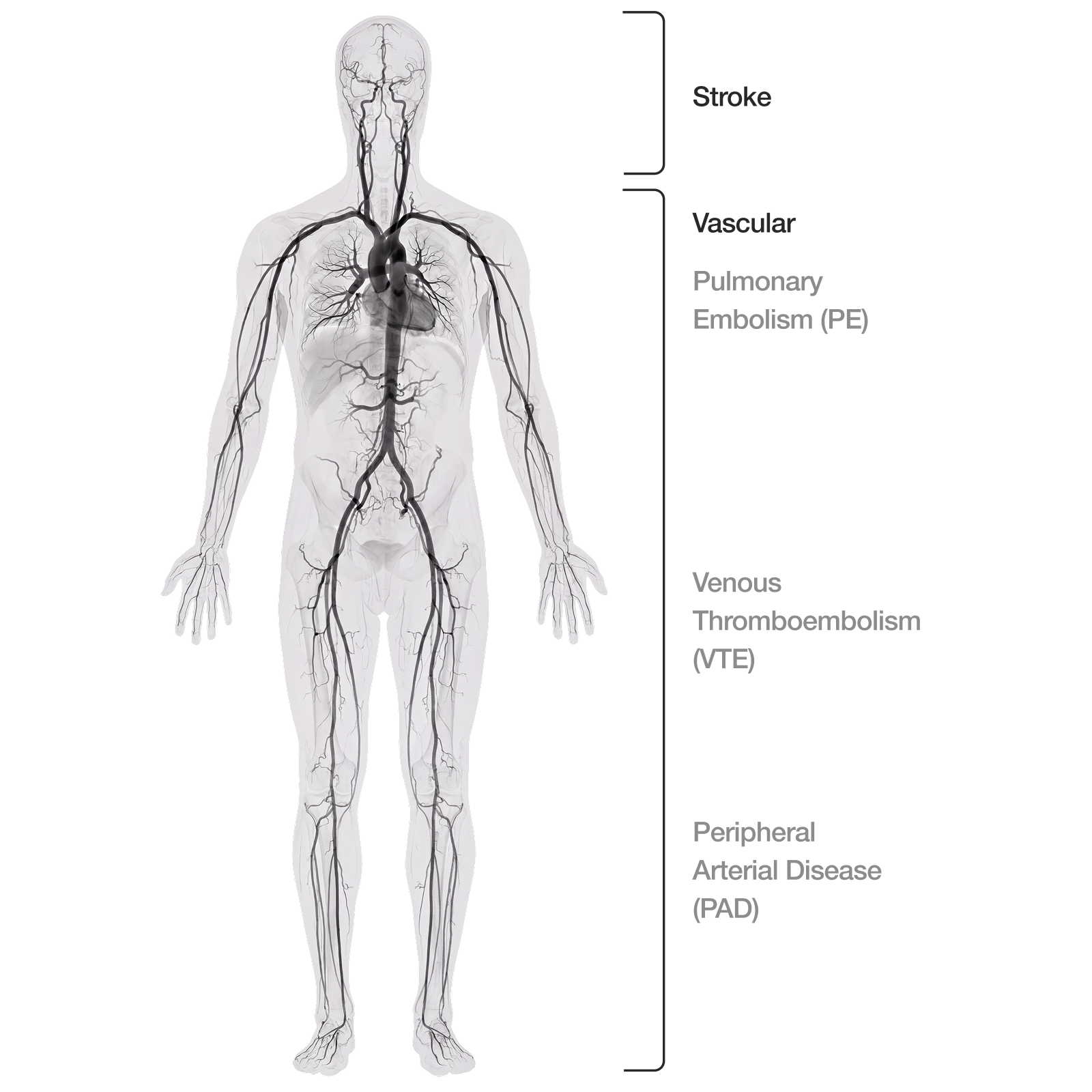 Full-body illustration showing thrombectomy treatment sites from head to toe