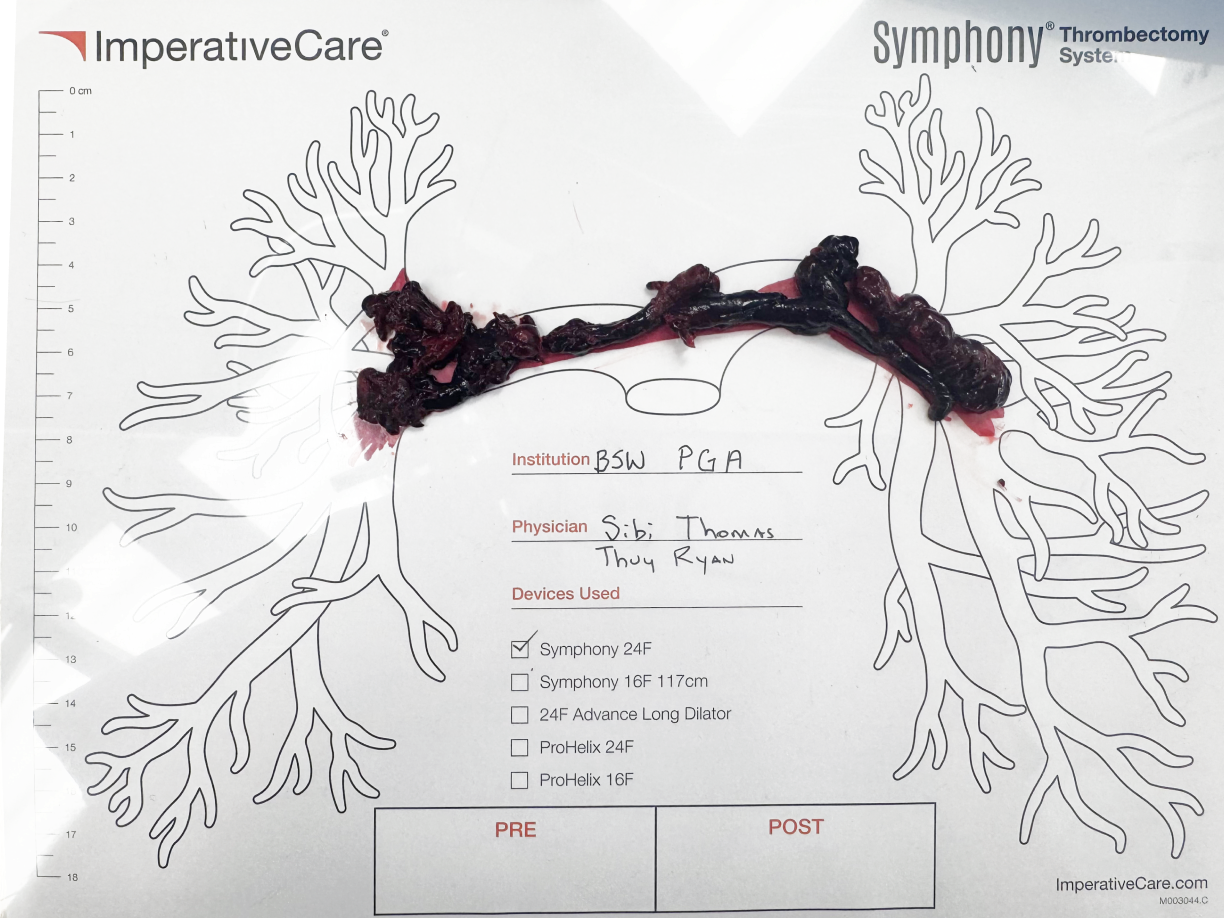 Clot removed with Symphony, laid out on a pulmonary artery case card: Dr. Ryan and Tomas’s case