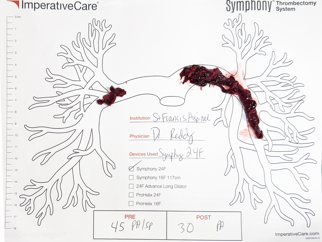 Clot removed with Symphony, laid out on a pulmonary artery case card: Dr. Reddy’s case
