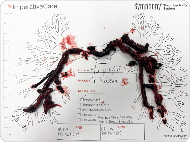 Clot removed with Symphony, laid out on a pulmonary artery case card: Dr. Brennan’s case