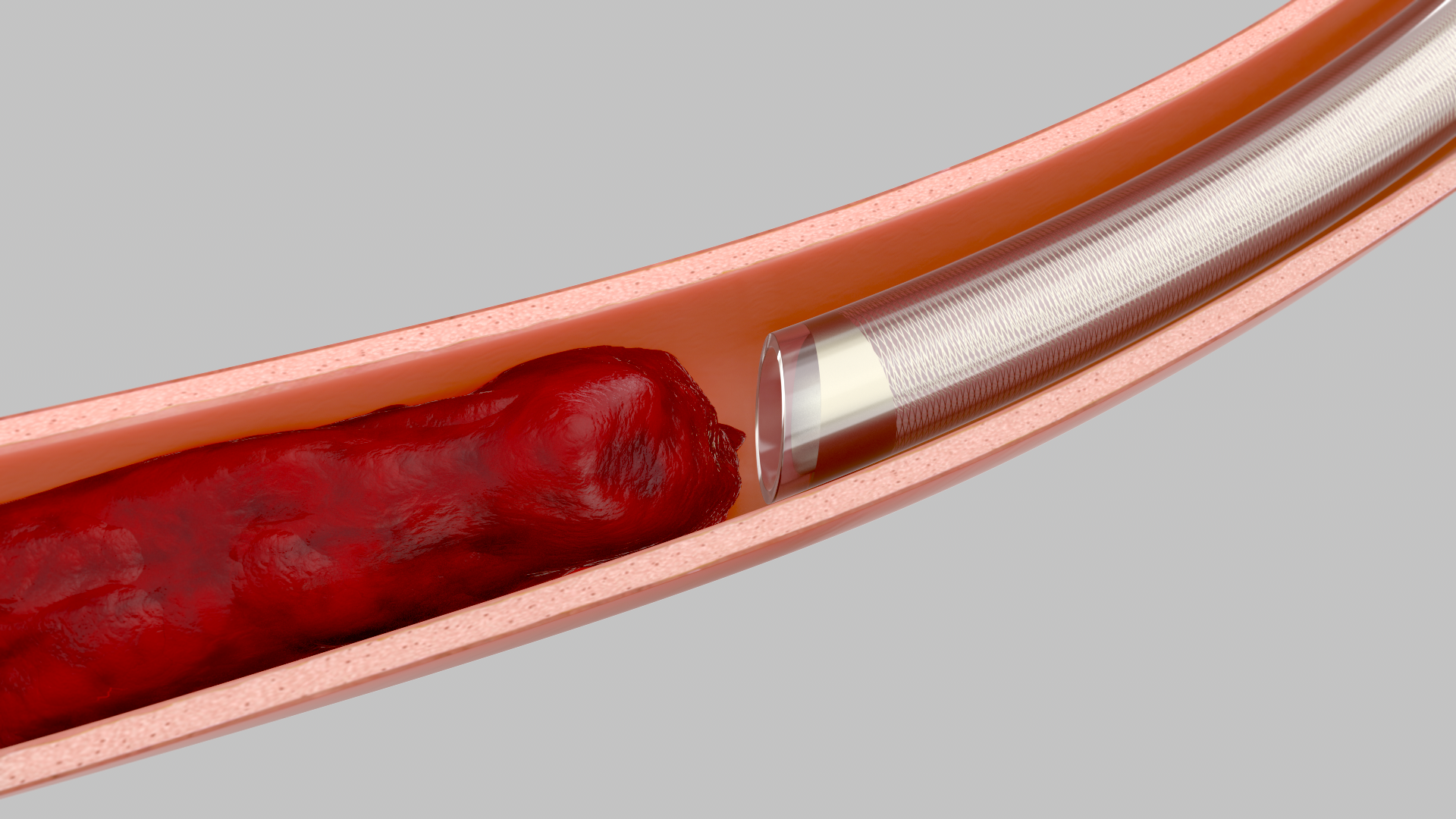 The Prodigy catheter’s Asymmetric Tip in a vessel