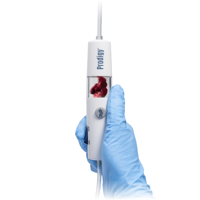 The Prodigy catheter with captured clot