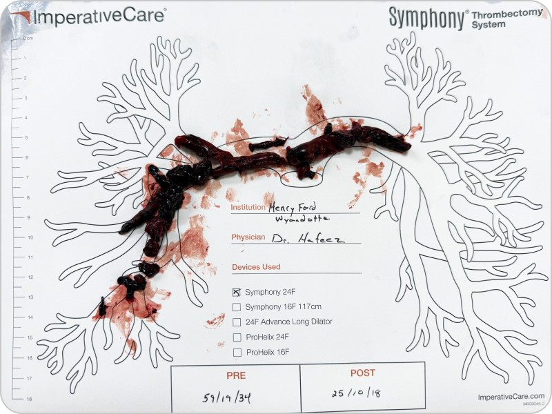 Clot removed with Symphony, laid out on a pulmonary artery case card: Dr. Hafeez’s case