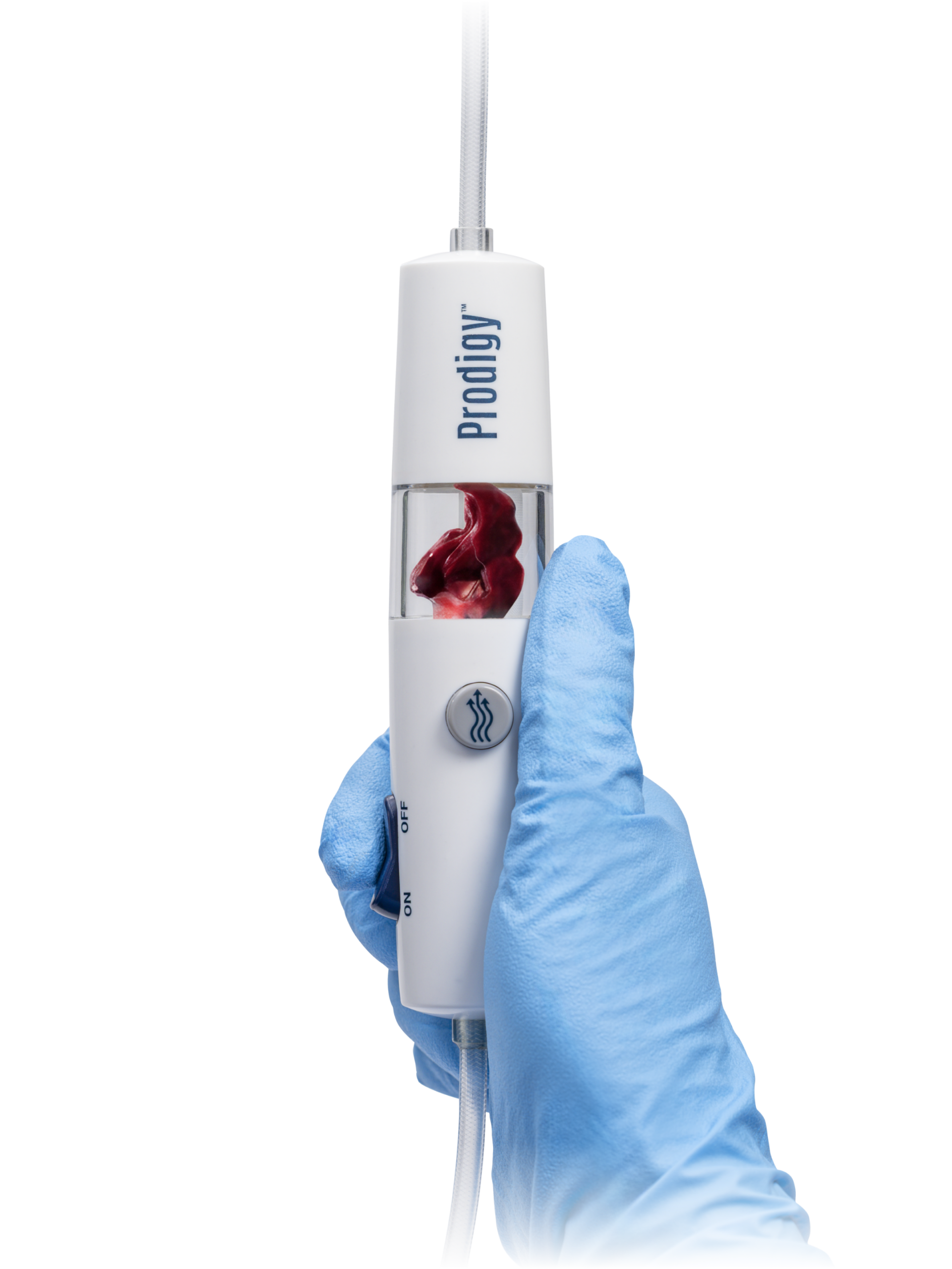 The Prodigy catheter with captured clot