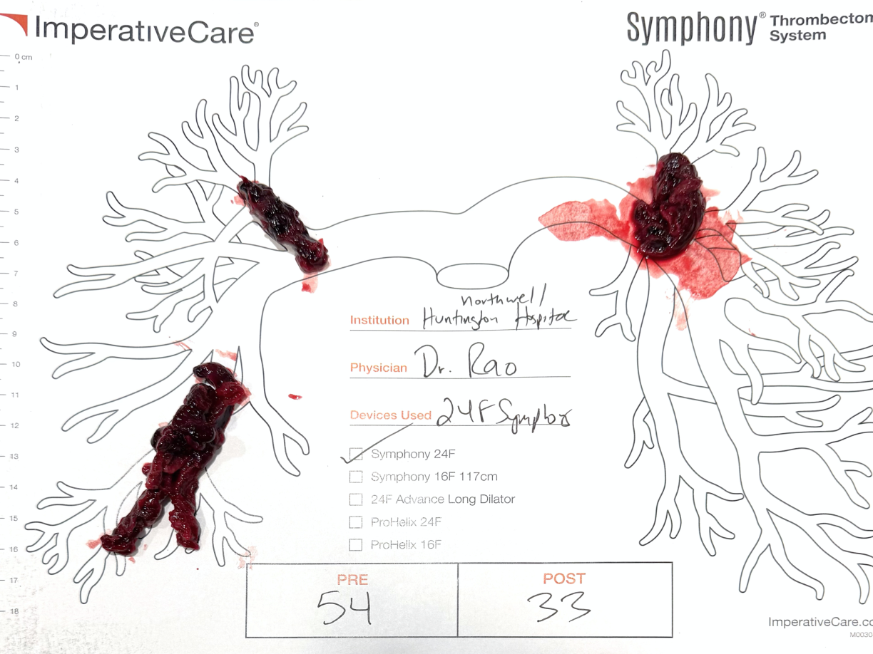 Clot removed with Symphony, laid out on a pulmonary artery case card: Dr. Rao’s case