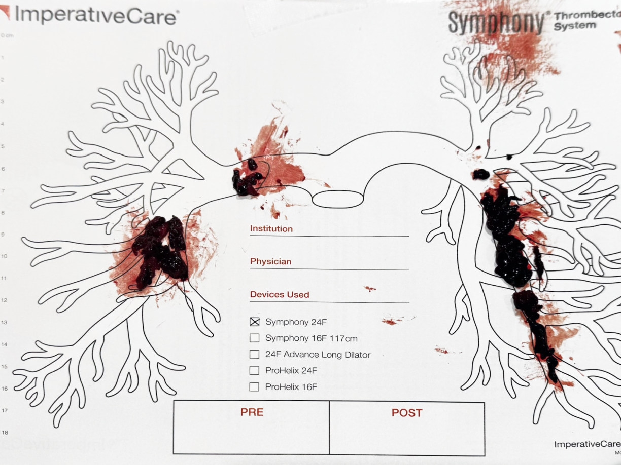 Clot removed with Symphony, laid out on a pulmonary artery case card: Dr. Saucier’s case