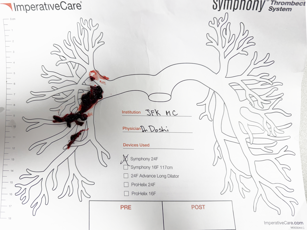 Clot removed with Symphony, laid out on a pulmonary artery case card: Dr. Doshi’s case