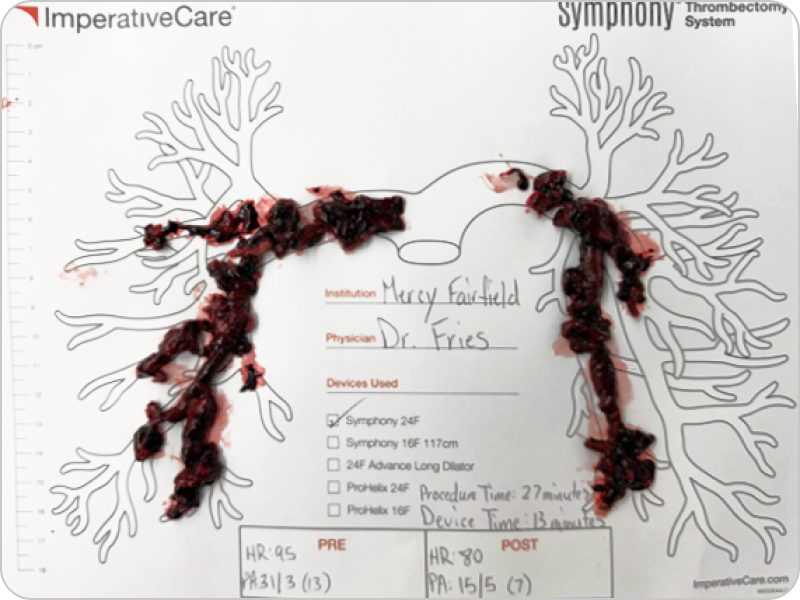 Clot removed with Symphony, laid out on a pulmonary artery case card: Dr. Fries’s case