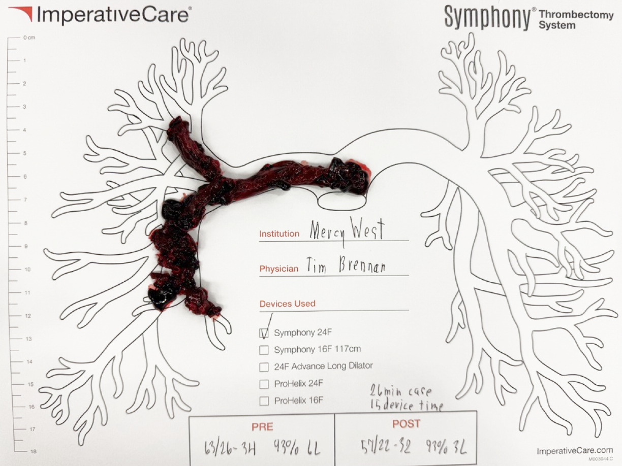 Clot removed with Symphony, laid out on a pulmonary artery case card: a second case of Dr. Brennan’s