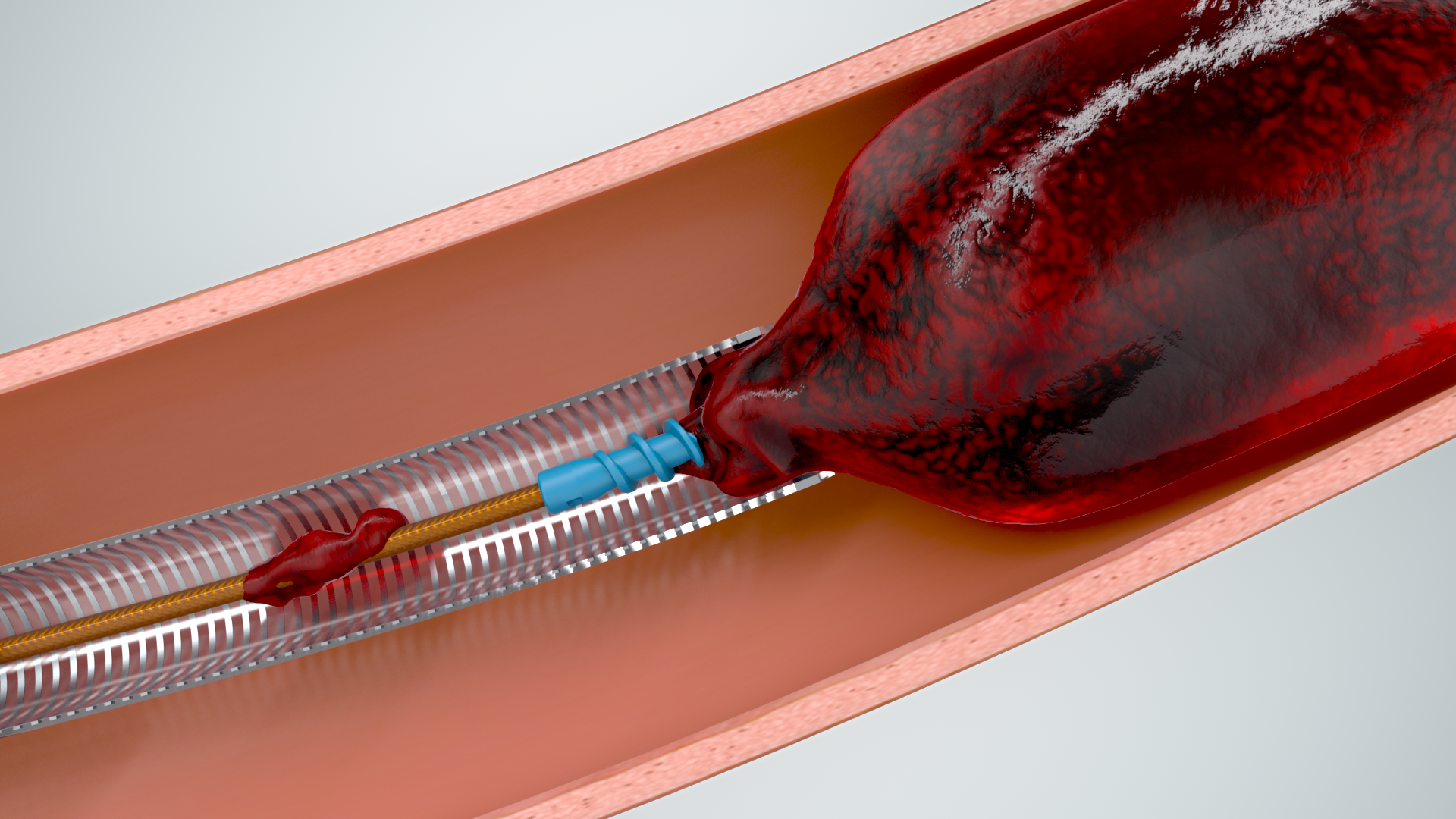 The Symphony 24F catheter with the ProHelix mechanical assist engaging clot